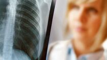  Potensi Patah Tulang Pasien Osteoporosis Bisa Dicegah    