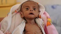 Puluhan Bayi Kurang Gizi Ditemukan di Distrik Sentani