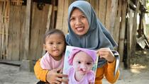2 Dekade, Smile Train Indonesia Sembuhkan 100.000 Anak Penderita Bibir Sumbing