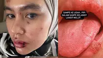 Tak Ingin Jadi Gunjingan, Ini Pernyataan Kartika Putri Terkait Wajah dan Lidahnya yang Melepuh