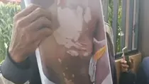 Kerap Cekcok, Suami Tega Siram Air Keras ke Tubuh Istrinya hingga Melepuh