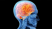 Waktu Paling Tepat untuk Deteksi Penyakit Demensia Alzheimer