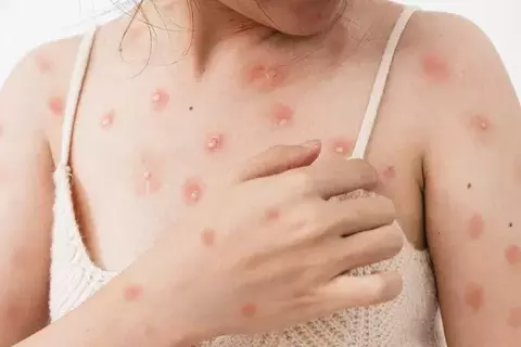Ini Kelompok Orang yang Rentan Terjangkit Wabah Mpox