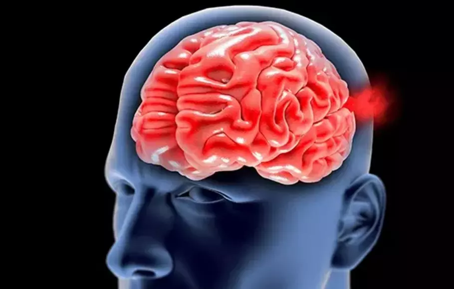 Understanding Brain Aneurysm: Causes, Symptoms, and Risks | Beritasatu.com