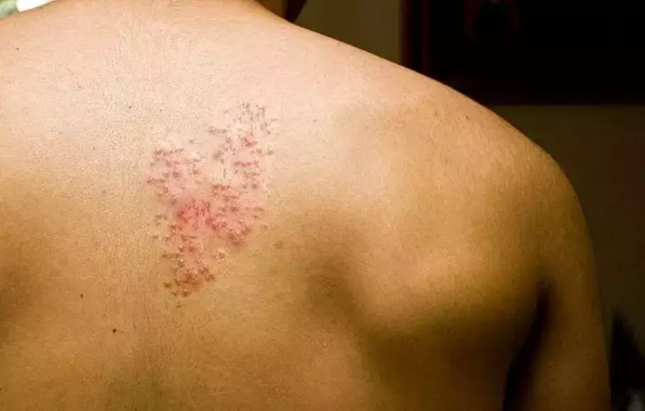 The Link Between Chickenpox and Shingles: Importance of Chickenpox Vaccination