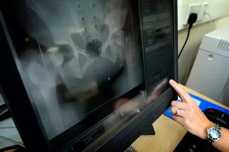 Pria di Inggris berusia 78 tahun diketahui memiliki tiga penis. - (Dailymail/DOK)