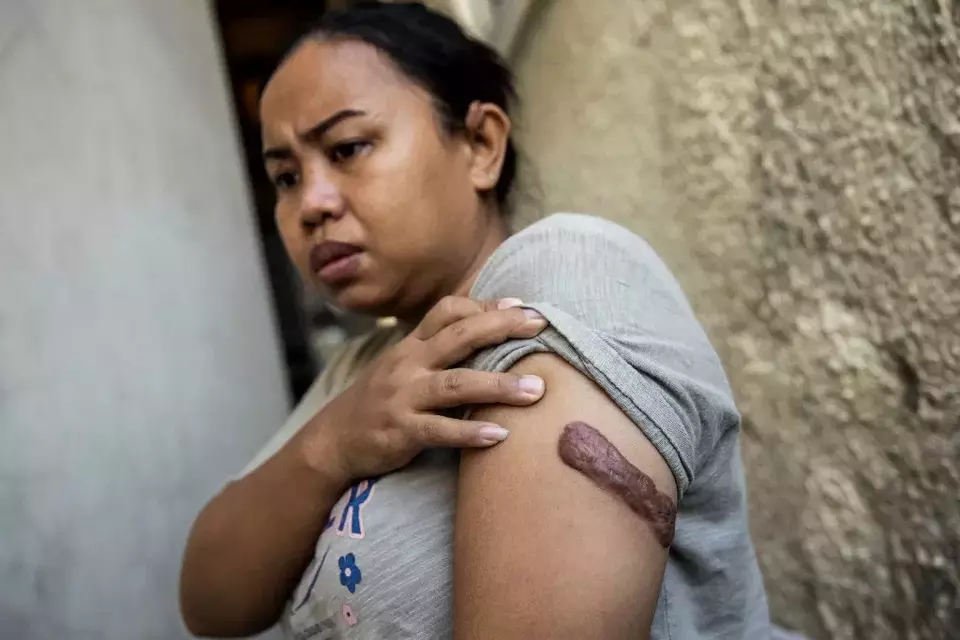 PRT Indonesia Kartika Puspitasari menunjukan bekas luka penyiksaan majikannya di Hong Kong.