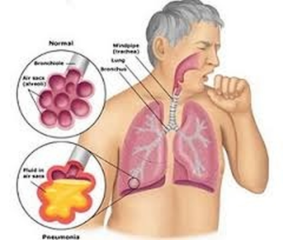 Tuberkulosis. Foto: terapitbc.com