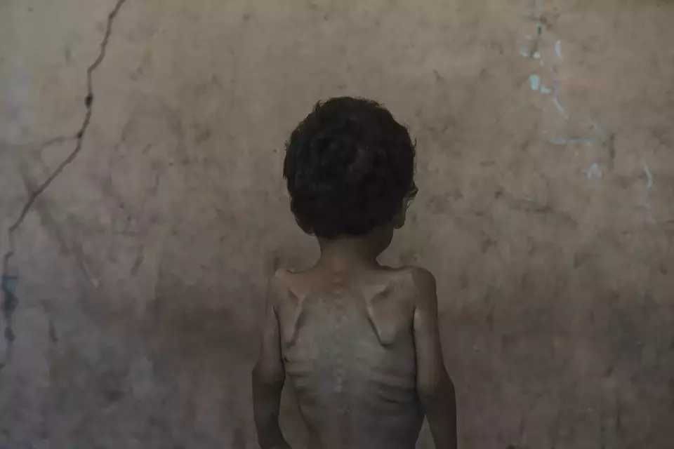 Yazan Abu Ful, seorang anak berusia 2 tahun yang menderita malnutrisi, berada di rumah keluarganya di kamp pengungsian Shati, di Gaza City pada Rabu (23/07/2025). (AP Photo/Jehad Alshrafi)