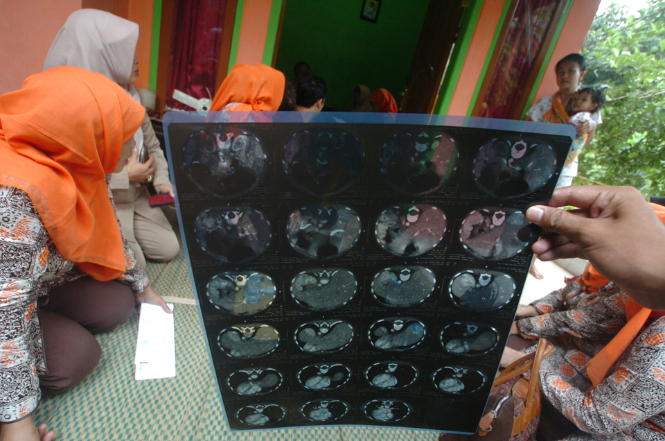 A member of the Indonesia Cancer Foundation (YKI) holds up an X-ray photo during an event commemorating the foundation’s 39th anniversary in Maleber village in Ciamis, West Java, on Tuesday (09/02). The YKI assists impoverished cancer patients with free medical treatments. More than 150 cancer patients in Ciamis district are currently receiving assistance from the charity. (Antara Photo/Adeng Bustomi)