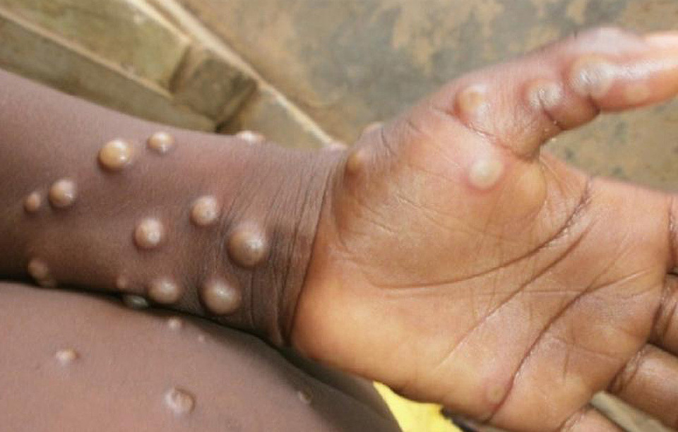Monkeypox. (Photo Courtesy of the World Health Organization)